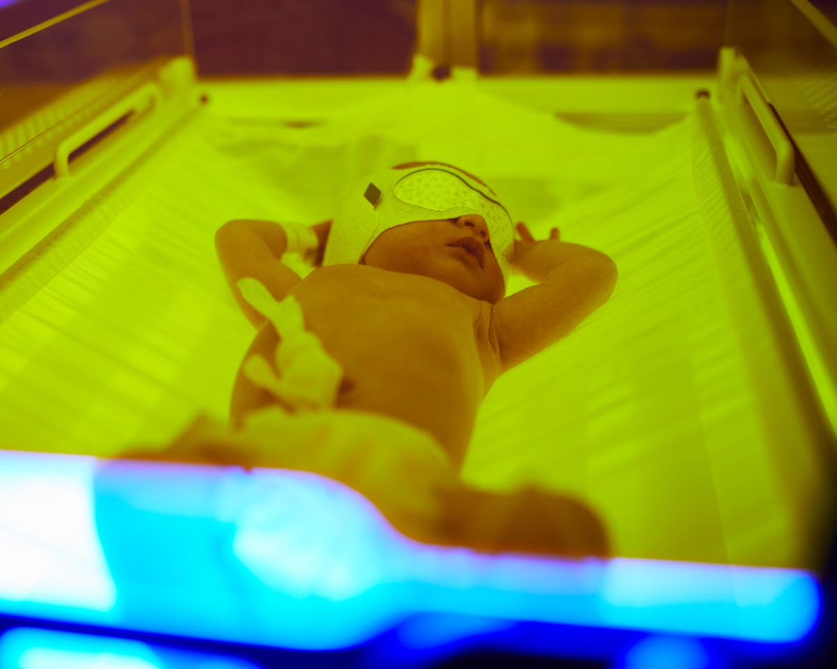 Coombs-Positive Jaundice in Newborns: Implications for Breastfeeding Support