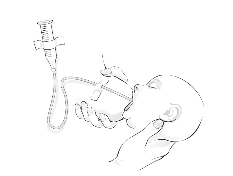 A Detailed Look at Alternative Feeding Methods for Supplementing Breastfed Babies: A Guide for Lactation Consultants