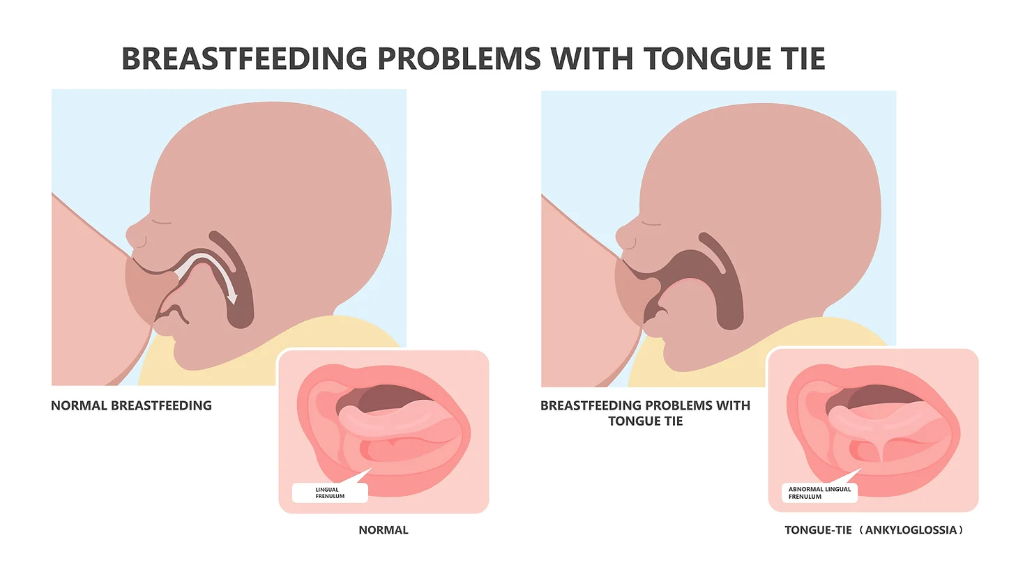 Understanding Tongue-Tie and Its Impact on Breastfeeding – What the Latest Evidence Says